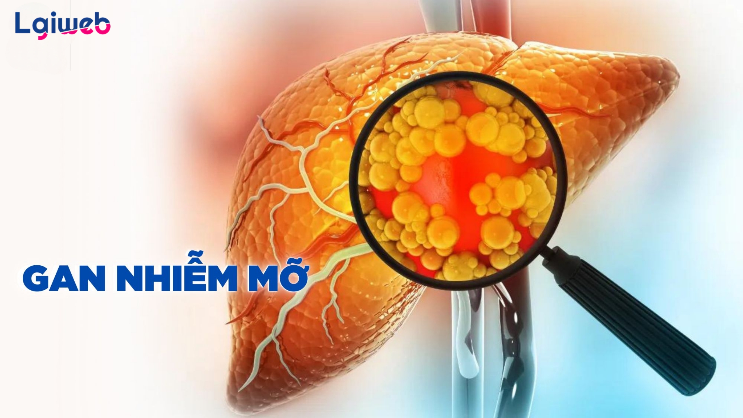 Bệnh Gan Nhiễm Mỡ Là Gì? Bệnh Gan Nhiễm Mỡ Là Gì?