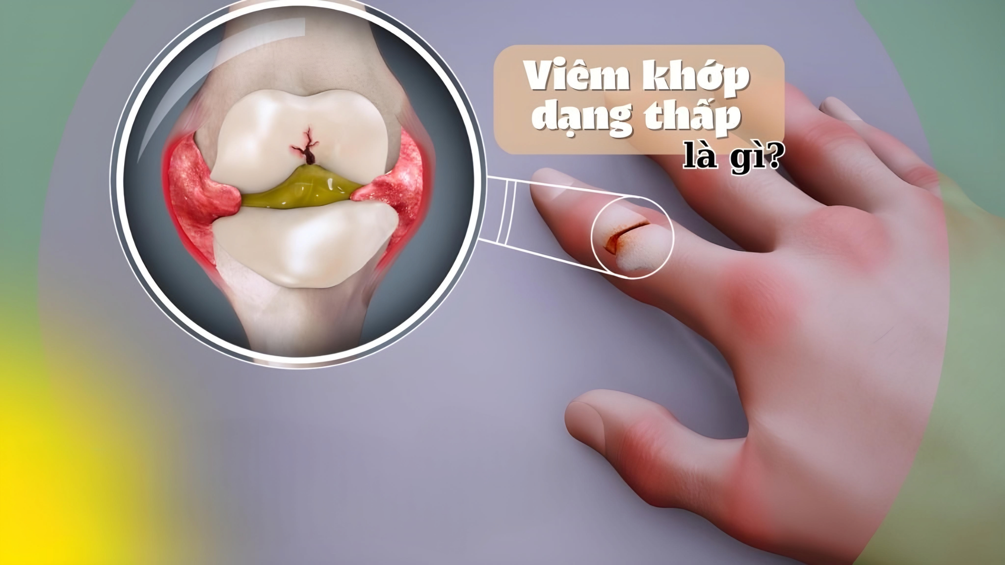 Viêm khớp dạng thấp là gì? Viêm khớp dạng thấp là gì?
