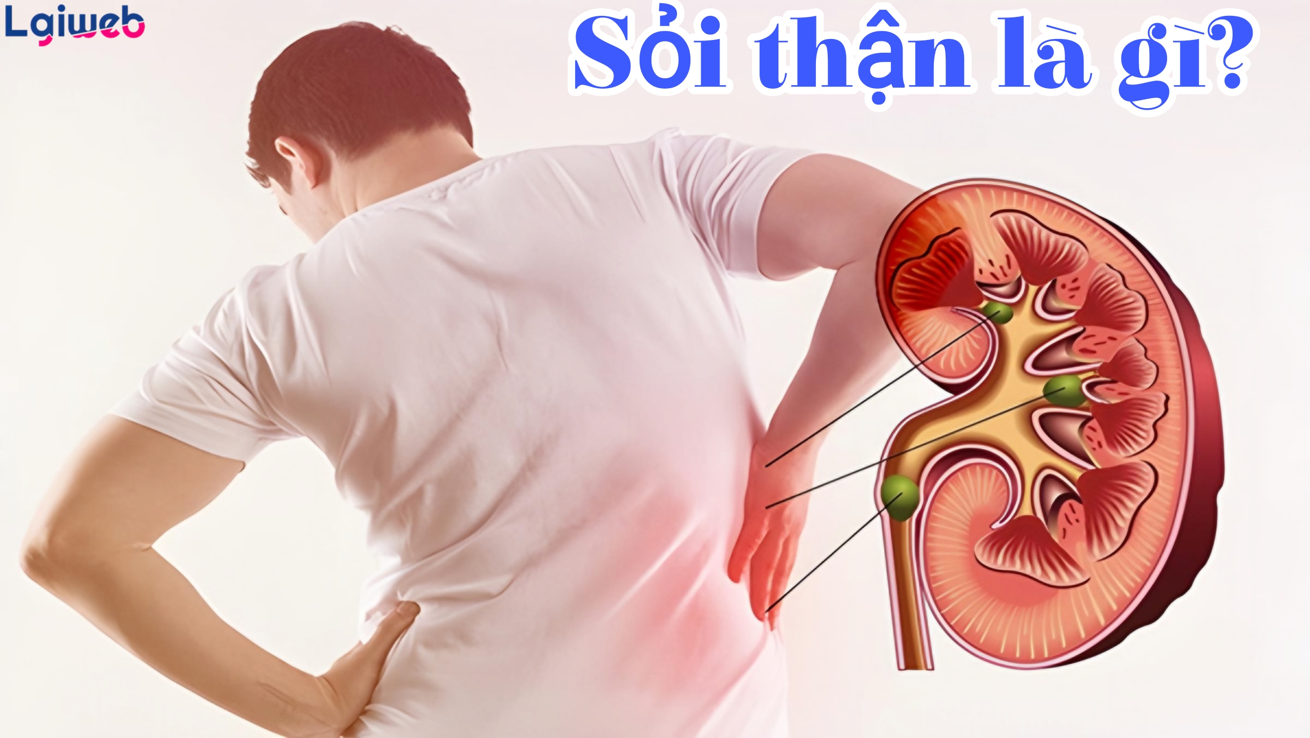 Sỏi Thận Là Gì? Sỏi Thận Là Gì?