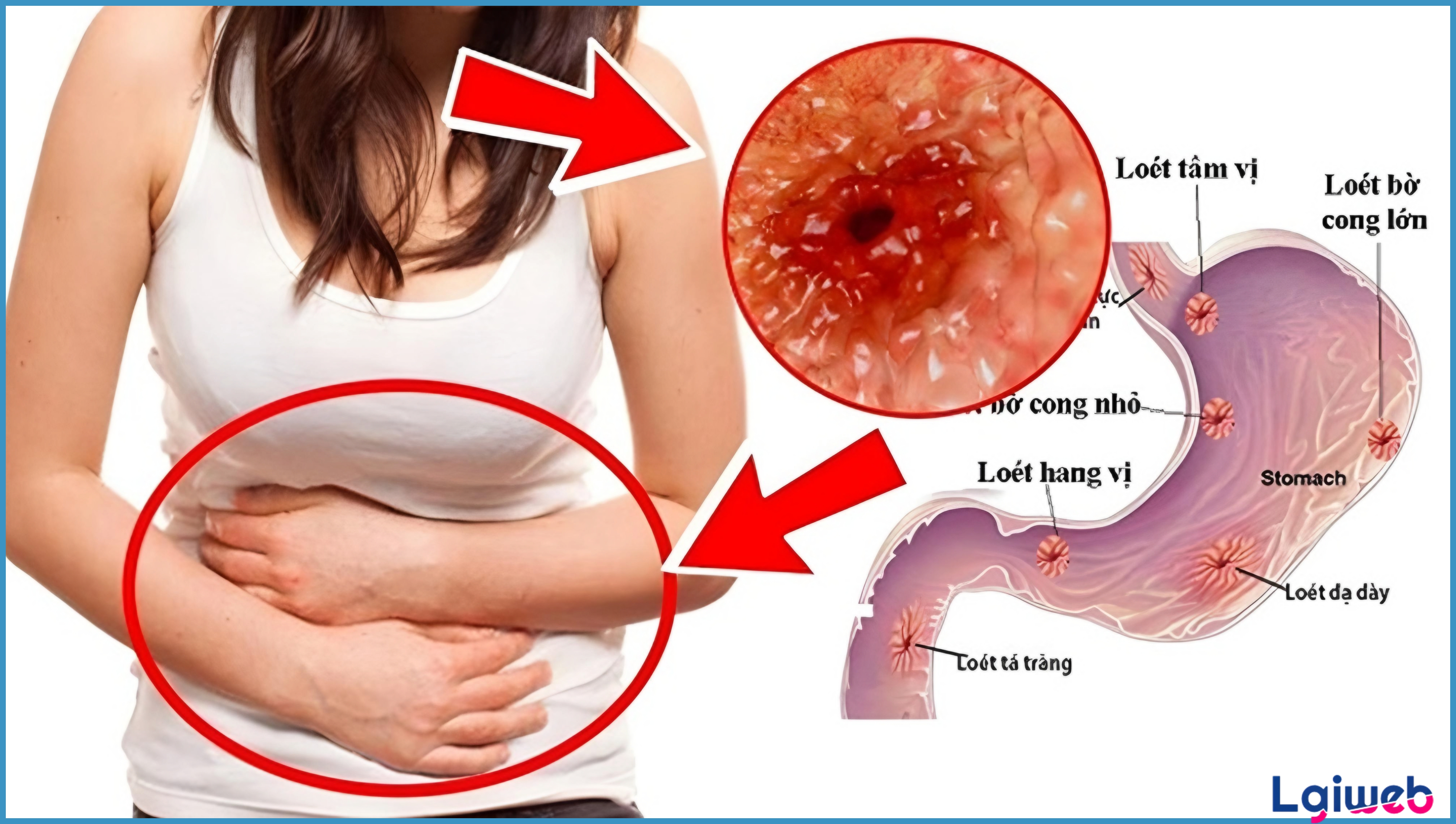 Loét Dạ Dày Là Gì? Loét Dạ Dày Là Gì?