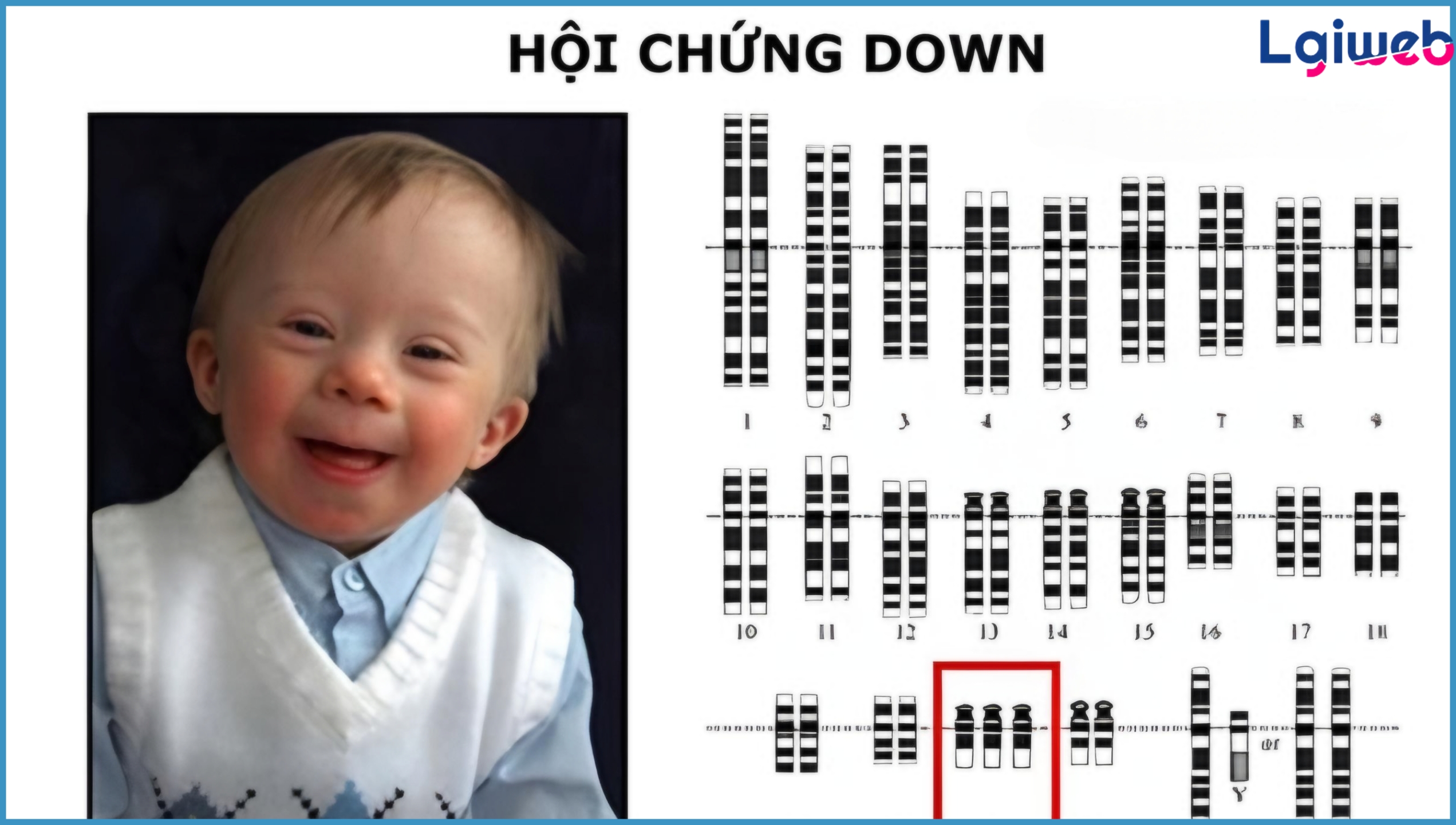 Hội Chứng Down Là Gì? Hội Chứng Down Là Gì?
