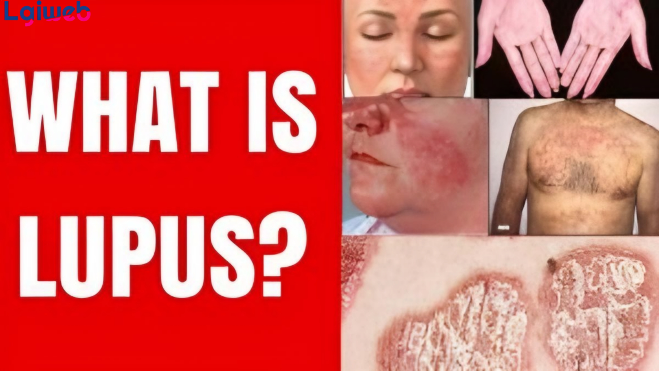 Lupus ban đỏ là gì? Lupus ban đỏ là gì?
