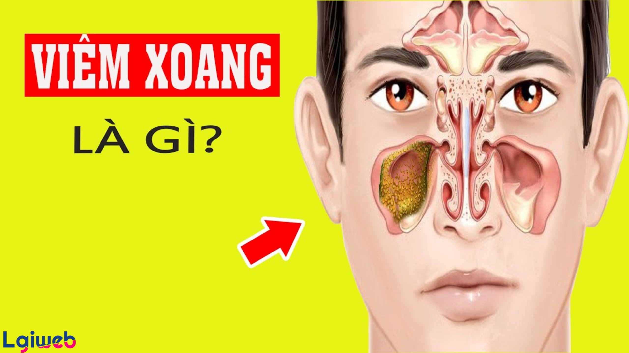 Viêm xoang là gì? Viêm xoang là gì?