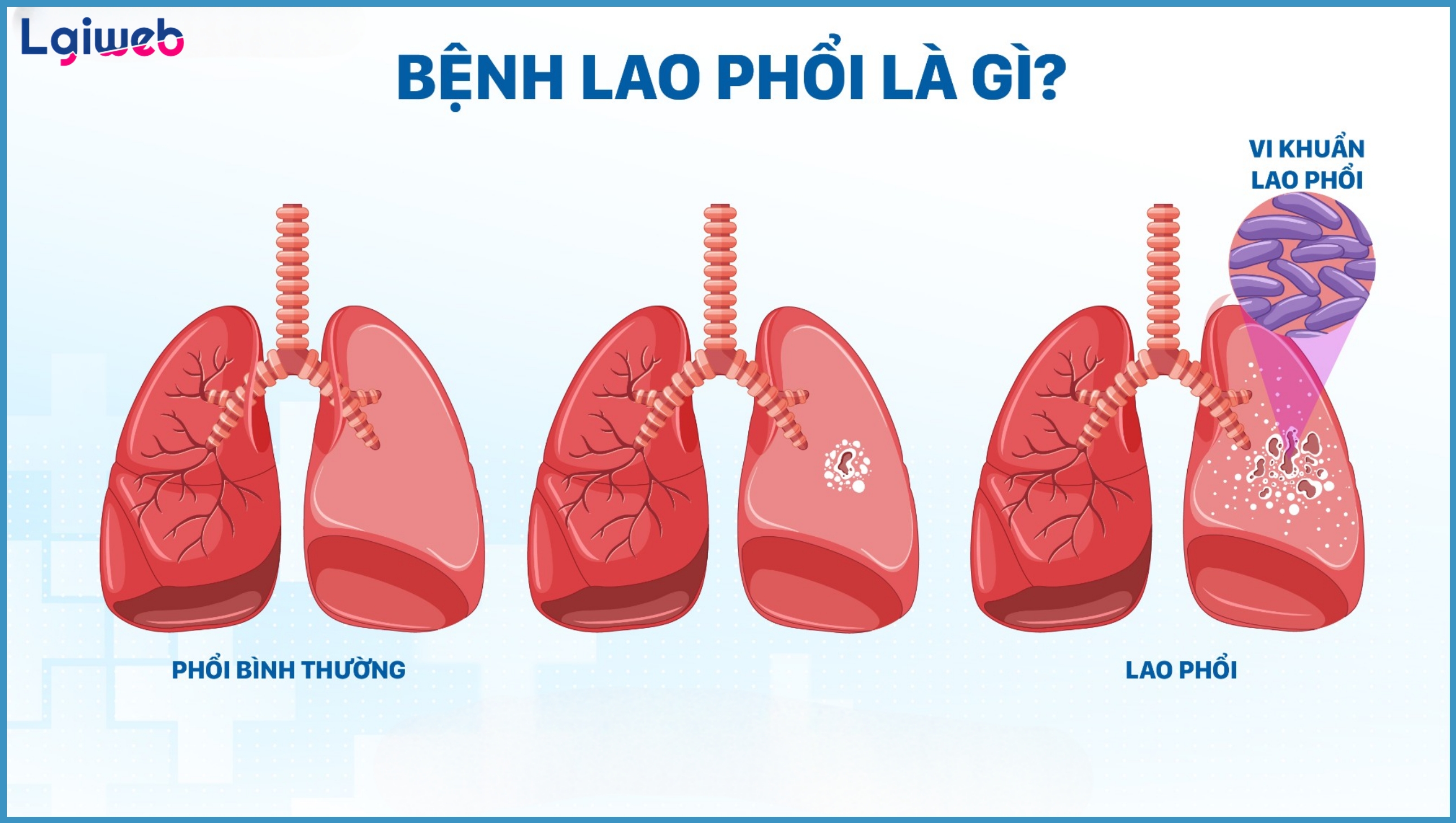 Lao Phổi Là Gì? Lao Phổi Là Gì?