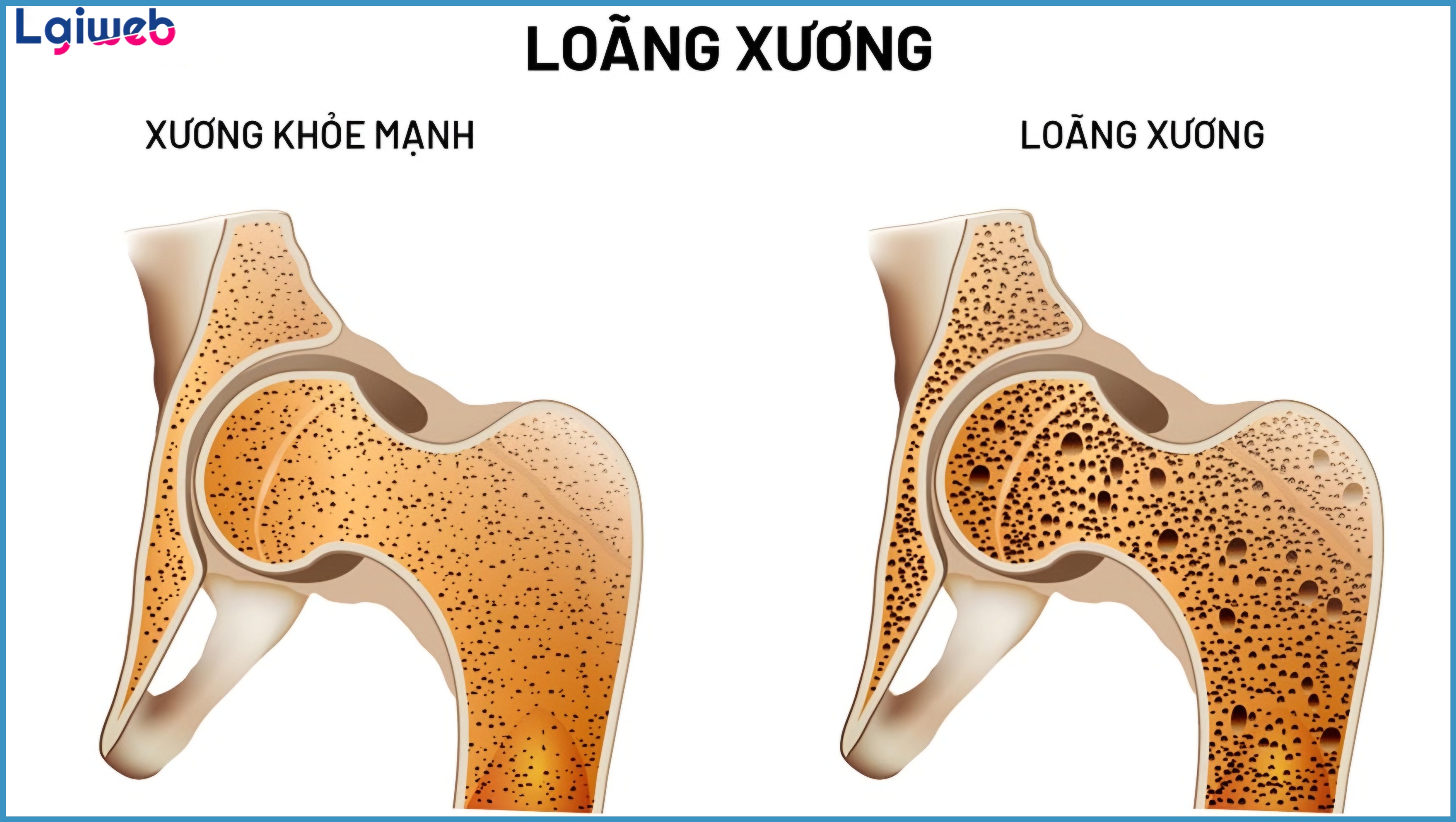 Loãng Xương Là Gì? Loãng Xương Là Gì?