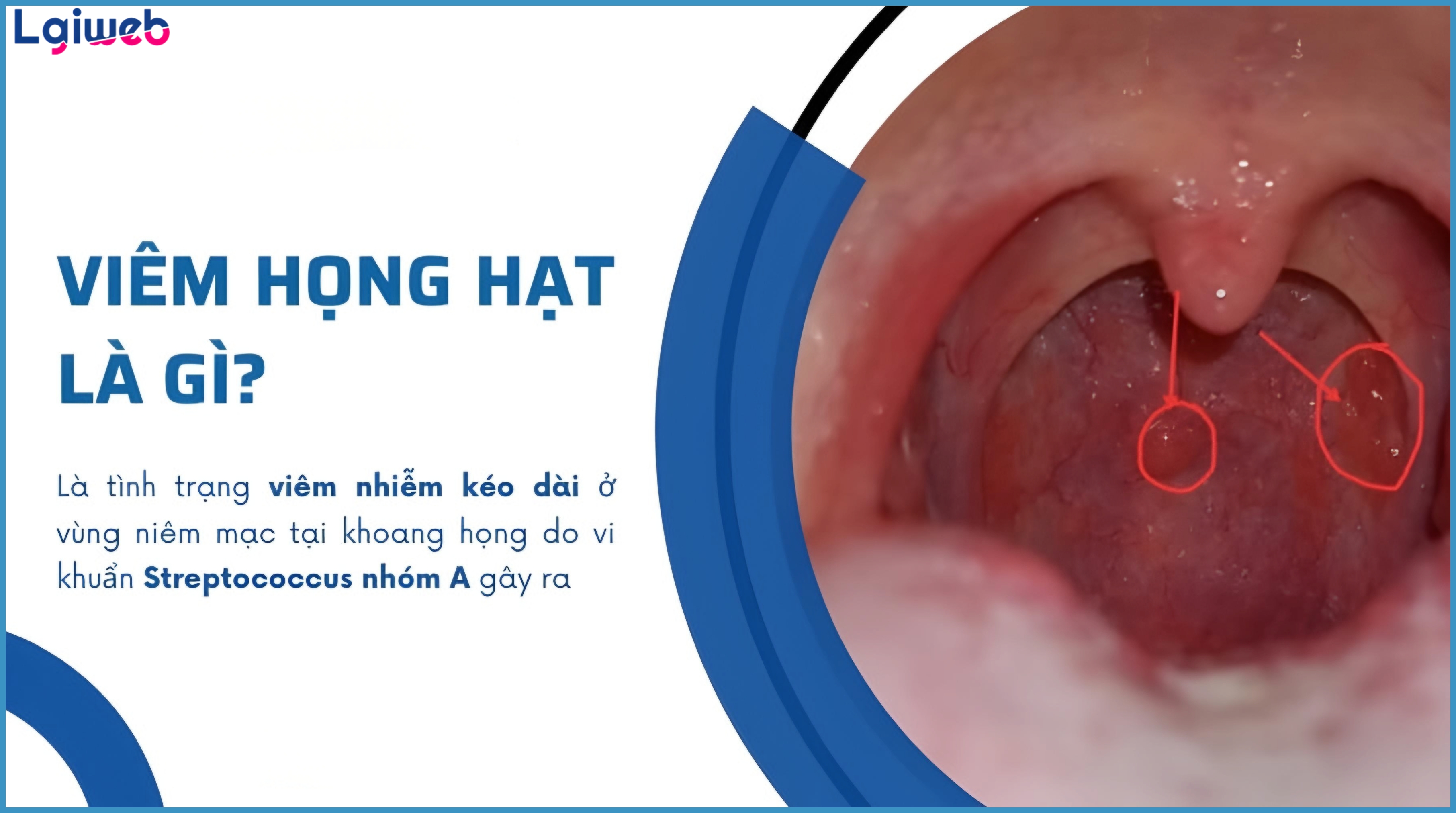 Viêm Họng Hạt Là Gì? Viêm Họng Hạt Là Gì?