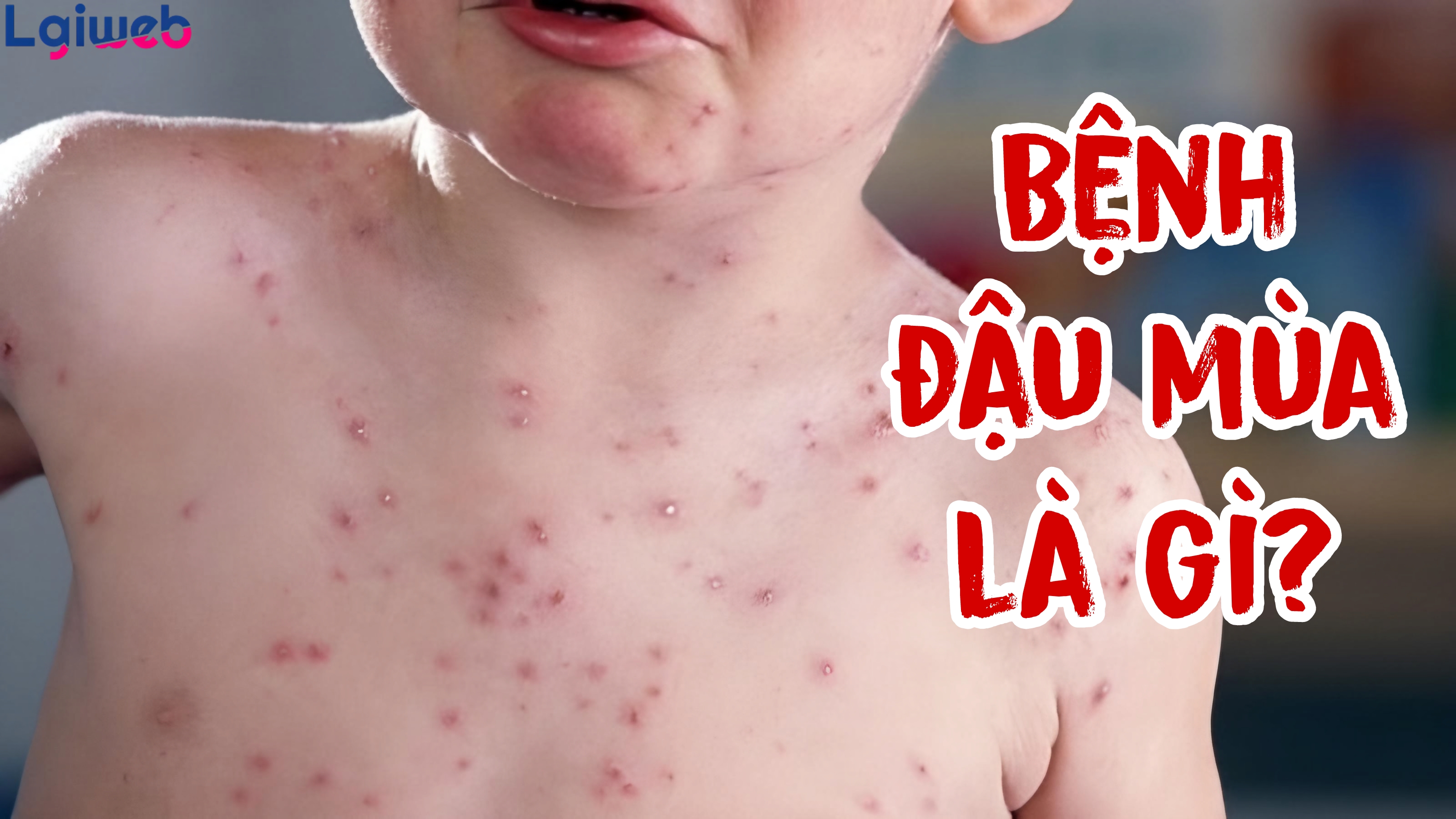 Bệnh đậu mùa là gì? Bệnh đậu mùa là gì?