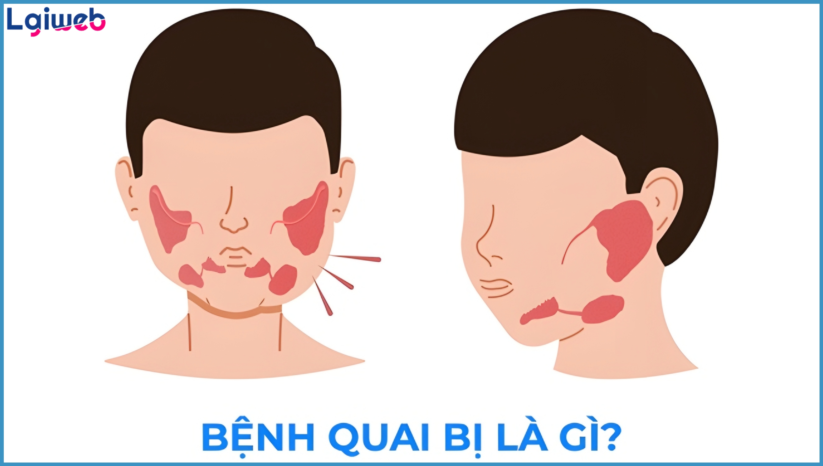 Bệnh Quai Bị là Gì? Bệnh Quai Bị là Gì?