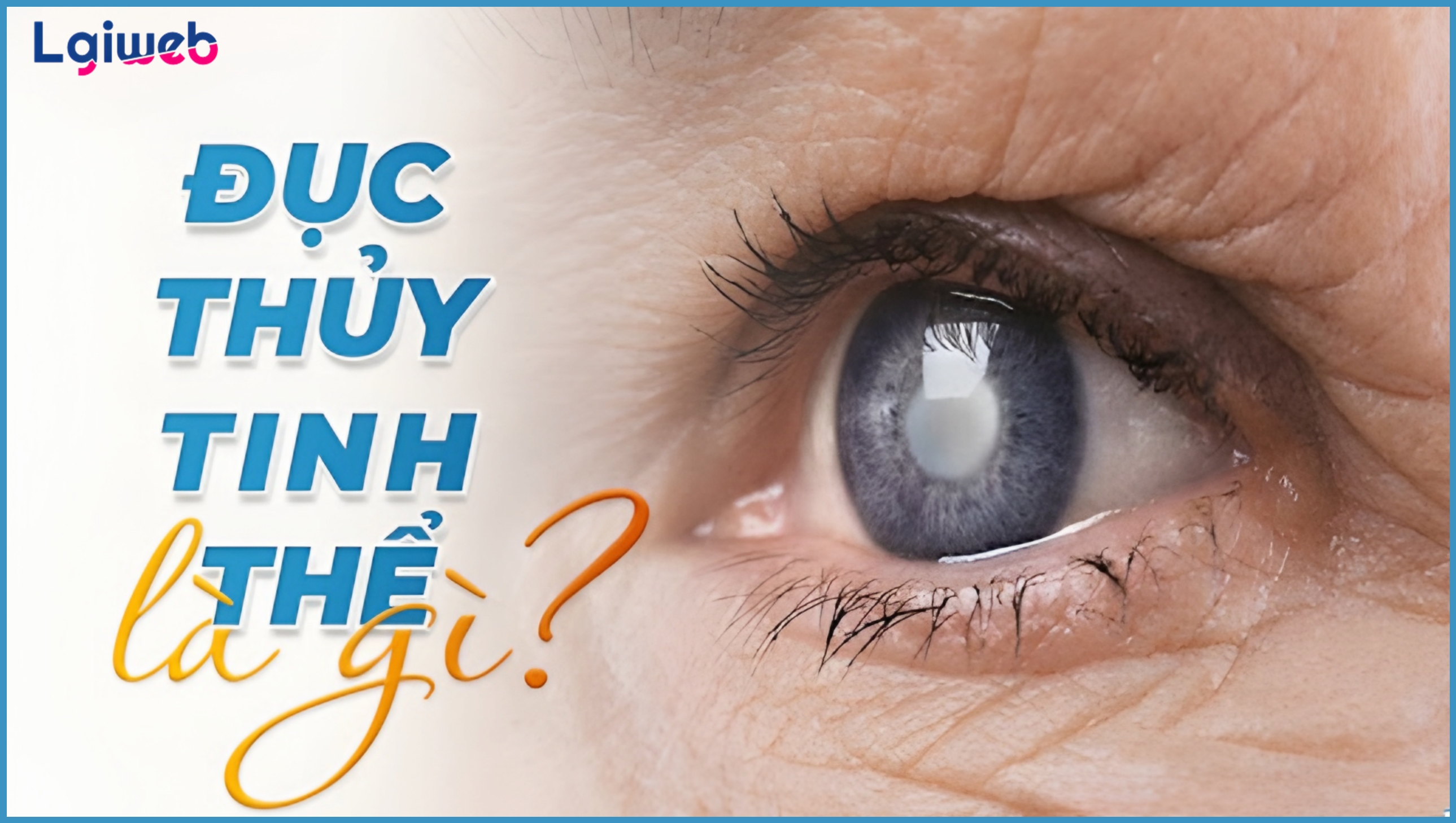 Đục Thủy Tinh Thể Là Gì? Đục Thủy Tinh Thể Là Gì?