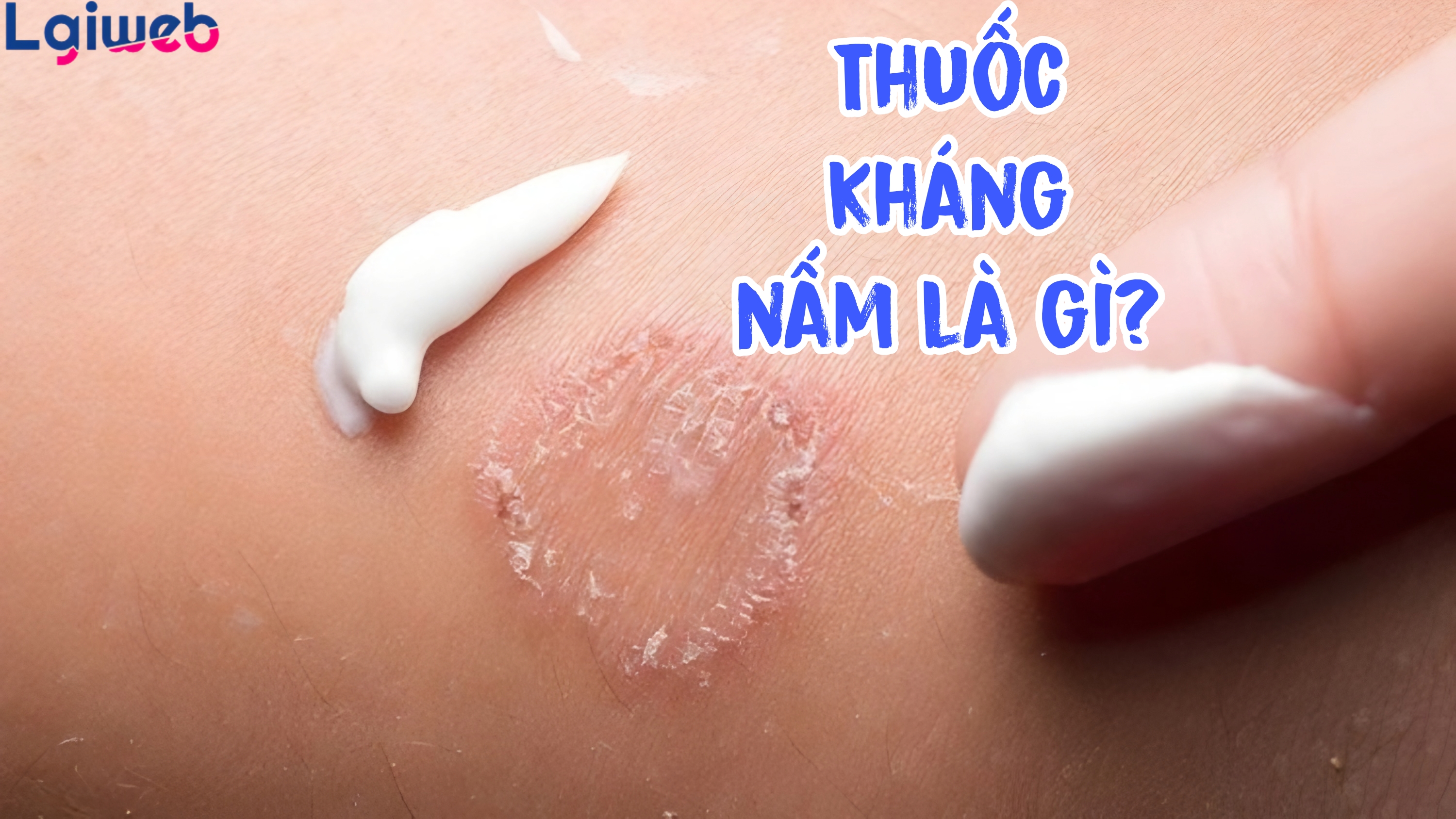 Thuốc Kháng Nấm Là Gì? Thuốc Kháng Nấm Là Gì?