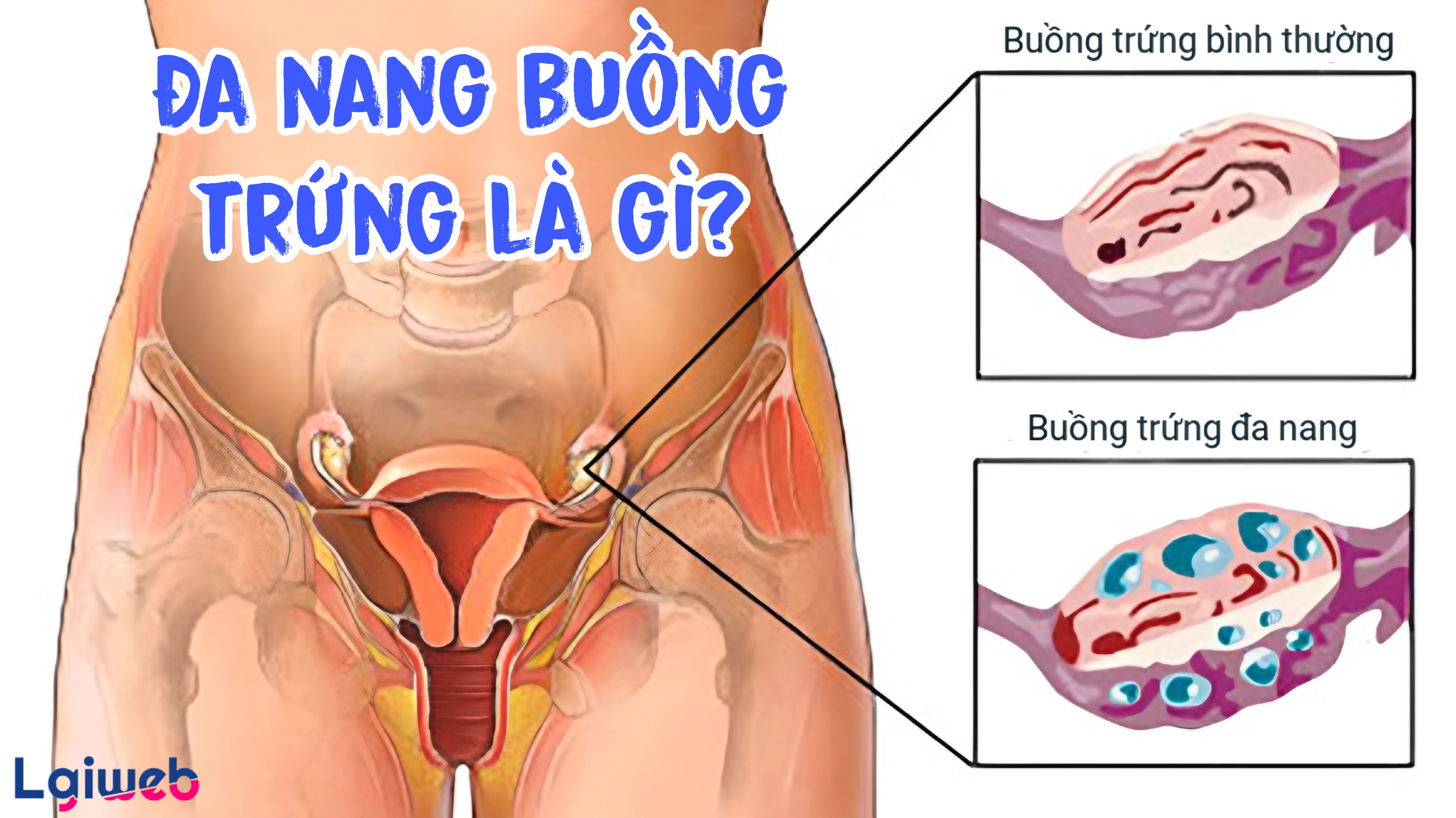 Hội chứng buồng trứng đa nang là gì? Hội chứng buồng trứng đa nang là gì?