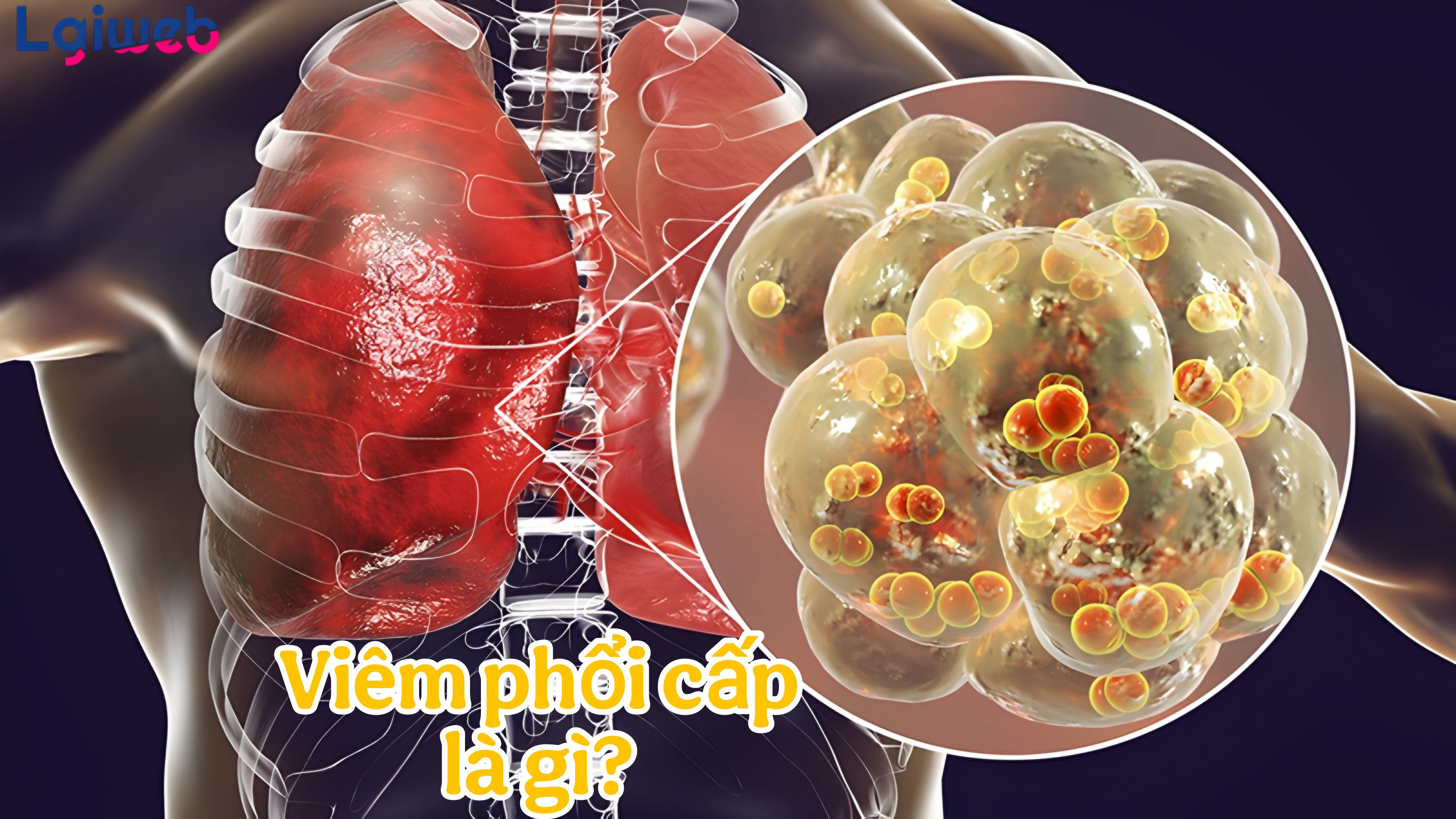 Bệnh Viêm Phổi Cấp Tính Là Gì? Bệnh Viêm Phổi Cấp Tính Là Gì?