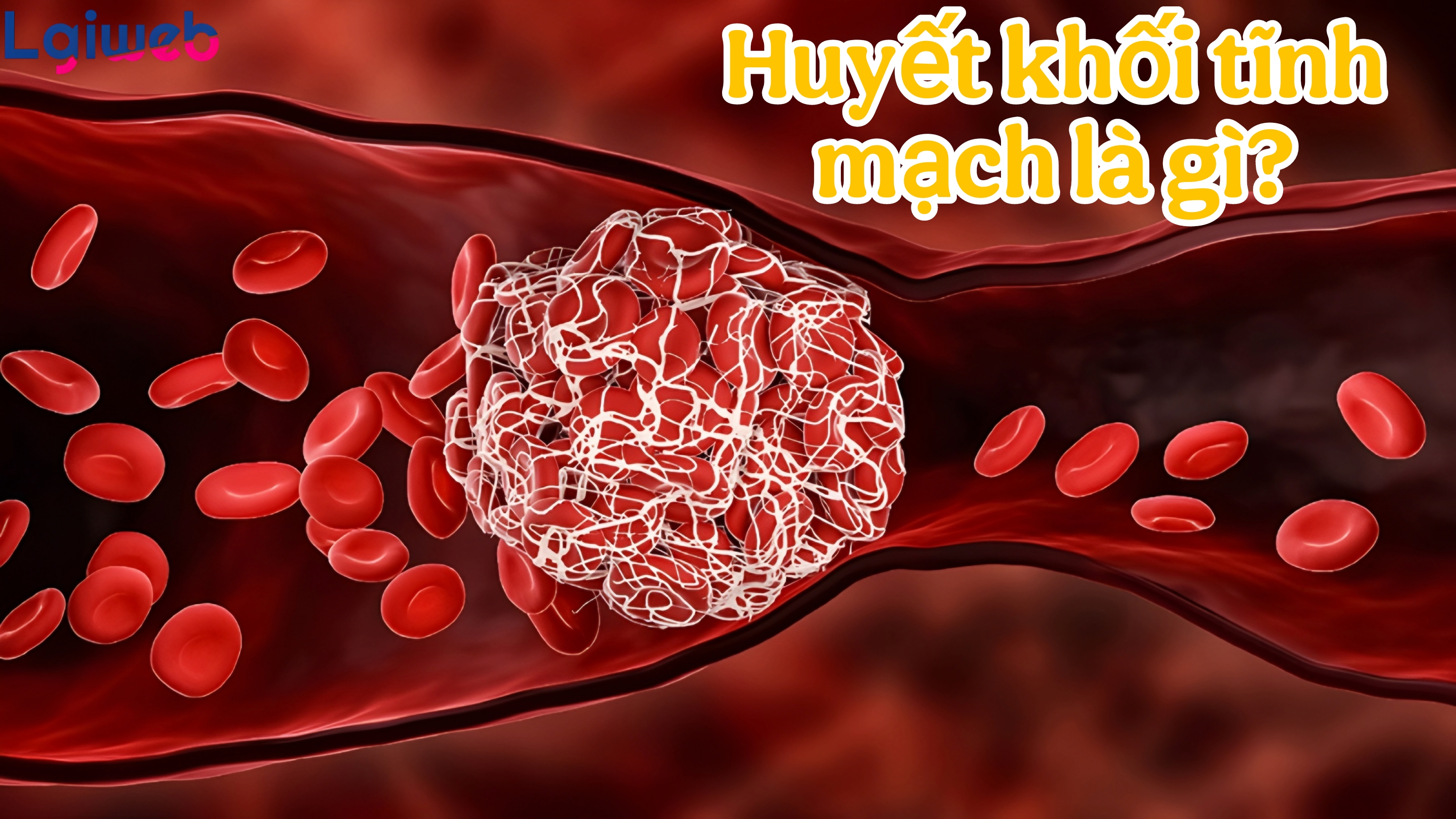 Huyết khối tĩnh mạch là gì? Huyết khối tĩnh mạch là gì?