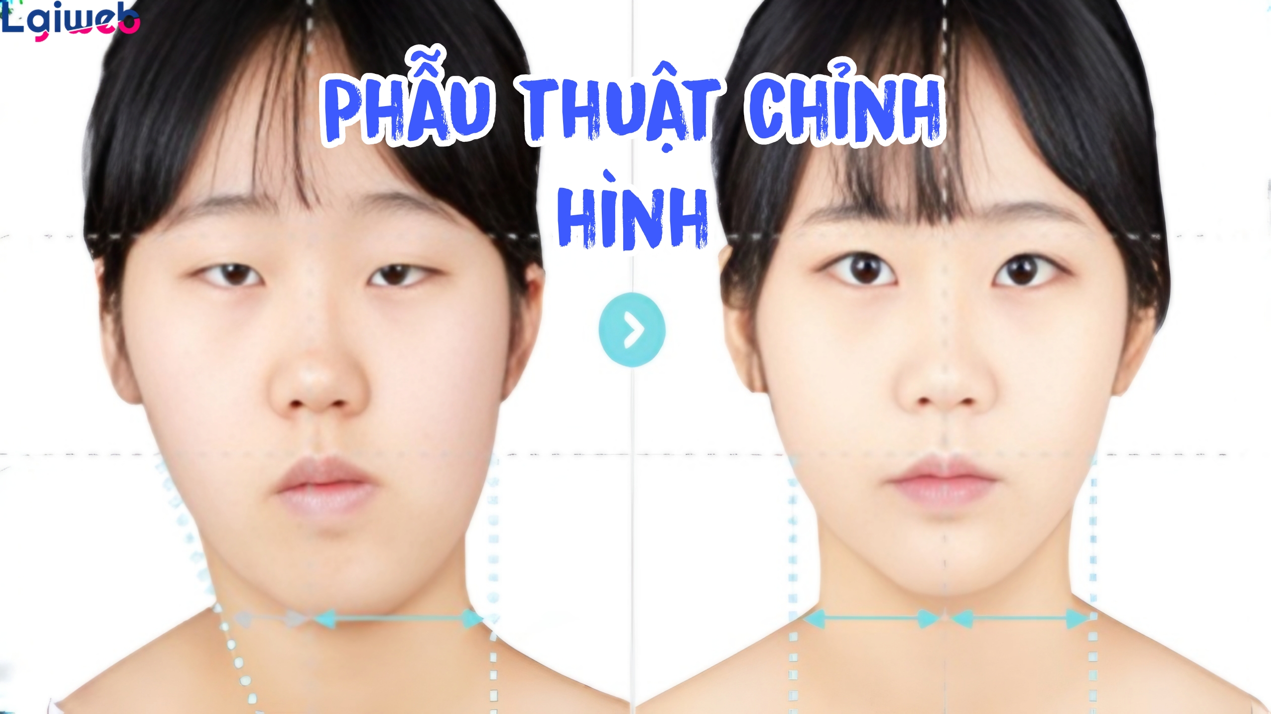Phẫu thuật chỉnh hình là gì? Phẫu thuật chỉnh hình là gì?