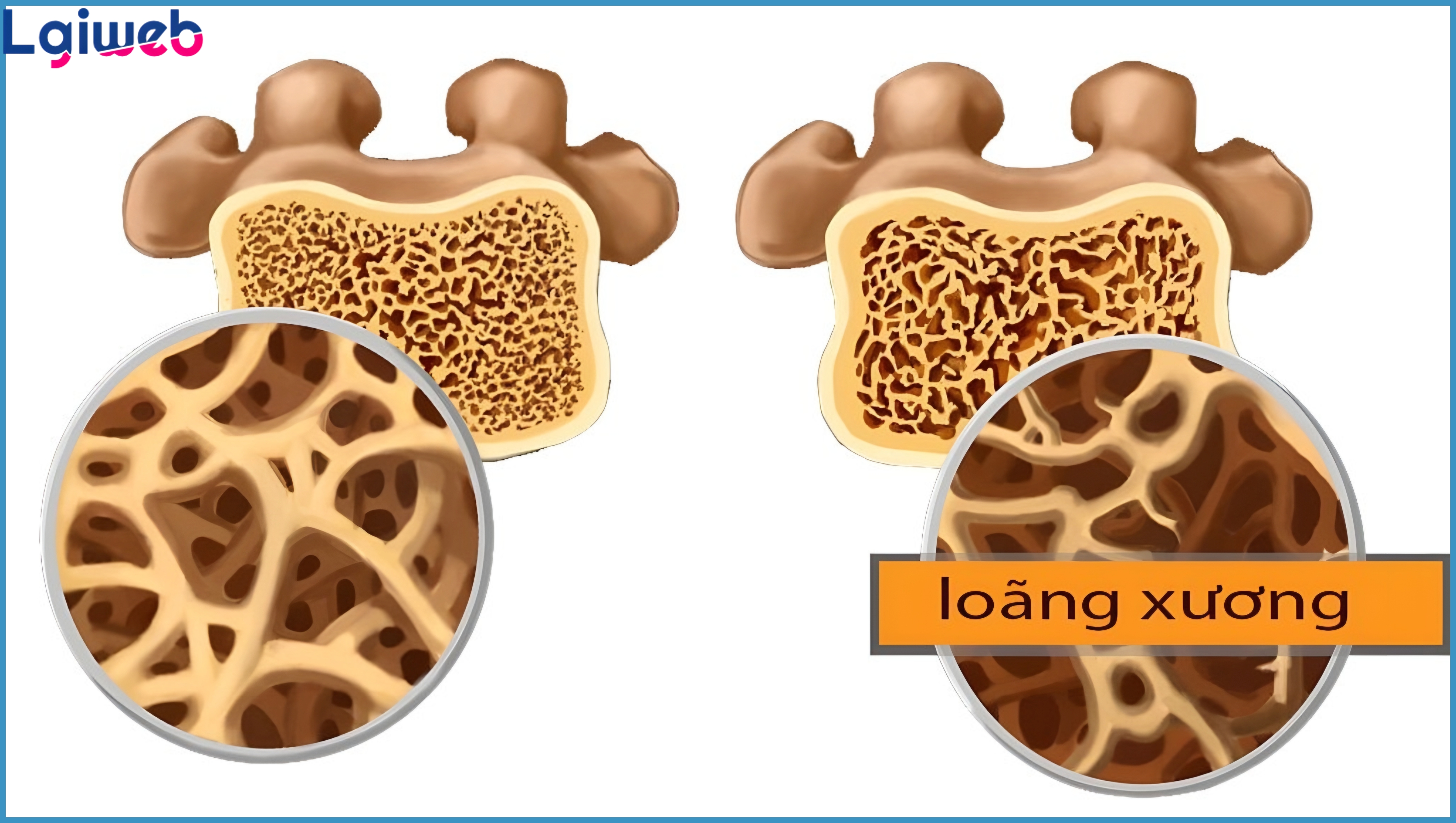 Đo mật độ xương là gì? Đo mật độ xương là gì?